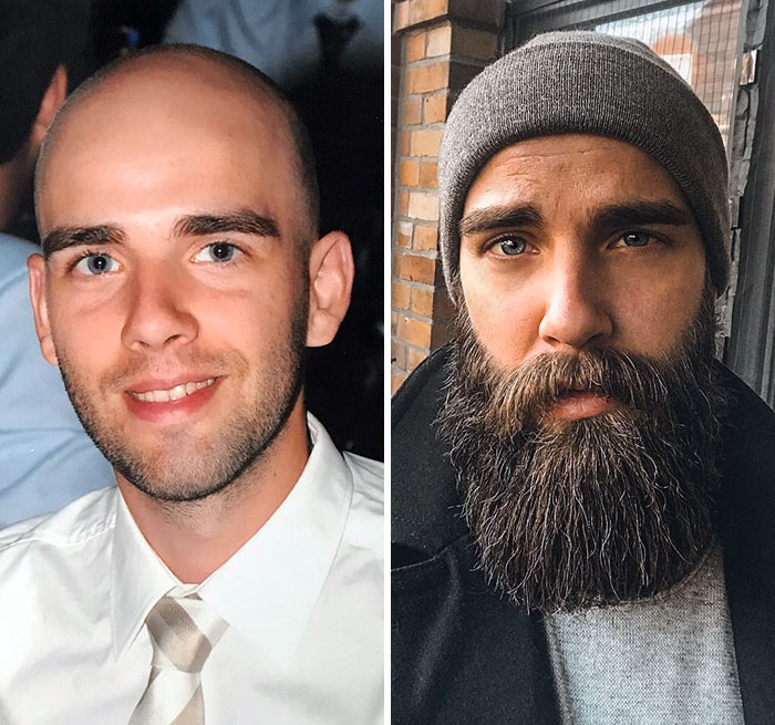 before after beard growing pics 21 6451103009b64 700