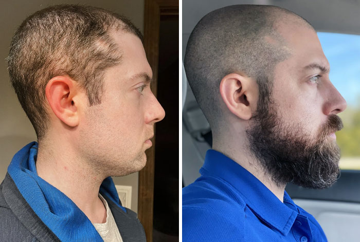 before after beard growing pics 33 6451154f95e32 700