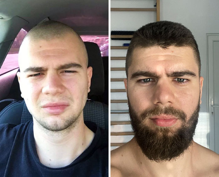 before after beard growing pics 48 64513138a1587 700